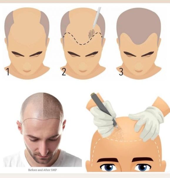 SMP - Scalp Micropigmentation